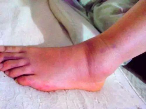 扭伤脚搞笑视频,搞笑瞬间让人捧腹大笑！